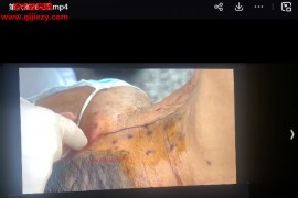 段作峰液波透骨疗法视频课程百度网盘下载学习
