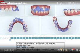 2020年邱易光隐适美视频课程8集百度网盘下载学习